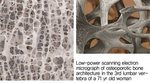 Figure3-3. 71세 여성의 골다공증을 앓고 있는 해면골 모습을 볼수 있으며 trabeculae의 줄기 부분의 연약한 모습을 관찰할 수 있다. 이러한 줄기 나무와 같은 부위에 미분화세포와 골모세포의 활성도가 낮을 수 밖에 없는 환경이 조성되어 있다.
